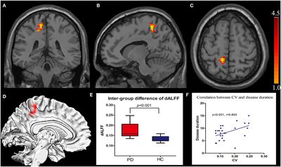 Dynamic Alterations of Spontaneous Neural Activity in Parkinson's Disease: A Resting-State fMRI Study